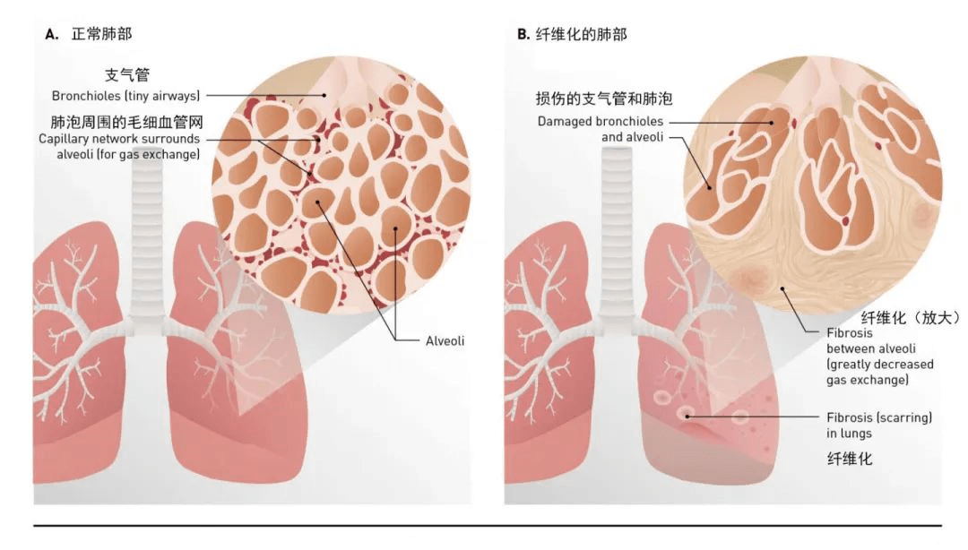 肺纖維化-肺炎-吸煙-特發(fā)性肺纖維化-肺功能-肺功能檢測(cè)儀-呼吸訓(xùn)練器-慢阻肺-哮喘-免疫力-咽炎-咳嗽-干咳-呼吸肌