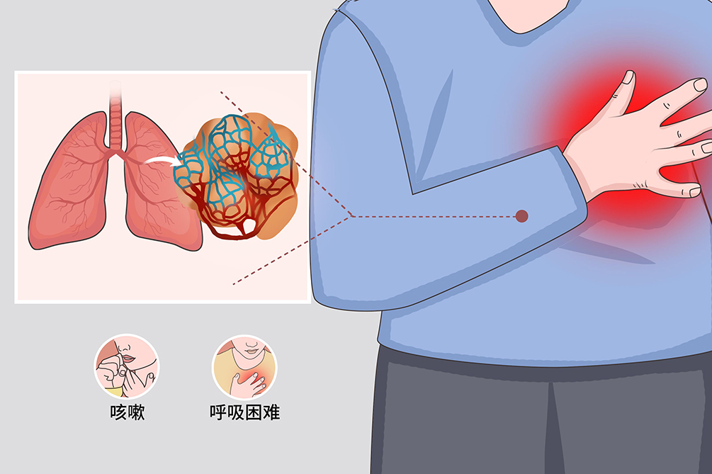 肺纖維化-肺炎-吸煙-特發(fā)性肺纖維化-肺功能-肺功能檢測(cè)儀-呼吸訓(xùn)練器-慢阻肺-哮喘-免疫力-咽炎-咳嗽-干咳-呼吸肌