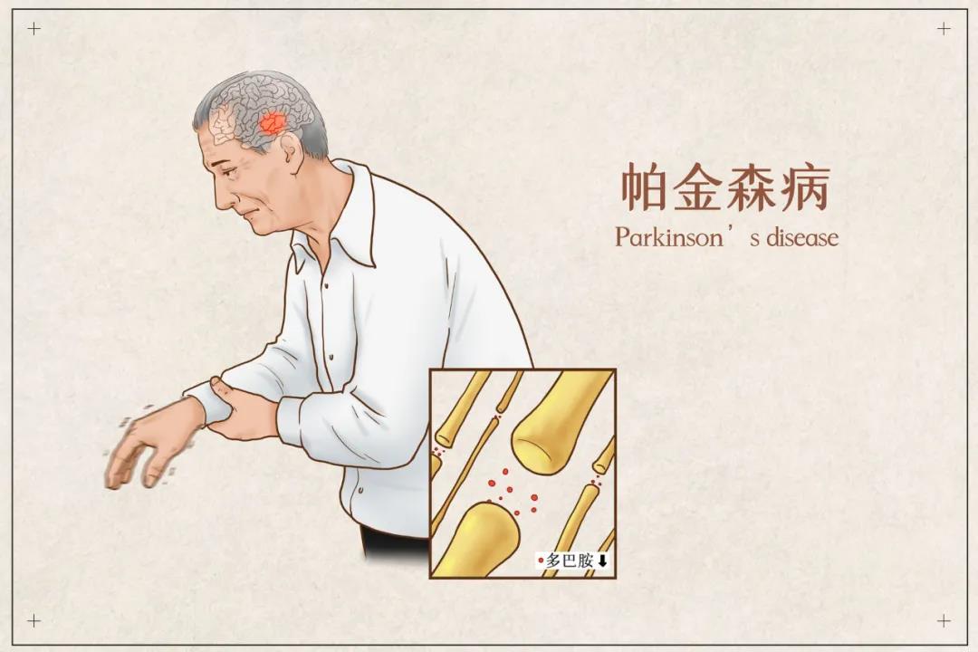 帕金森-肺炎-肺部感染-呼吸-康復(fù)-呼吸訓(xùn)練-呼吸操-呼吸訓(xùn)練器-呼氣檢測-吸氣檢測-肺功能檢查-肺功能檢測儀-肺康復(fù)-輔助呼吸訓(xùn)練-震顫-手抖-肌強(qiáng)直-呼吸抗阻訓(xùn)練 